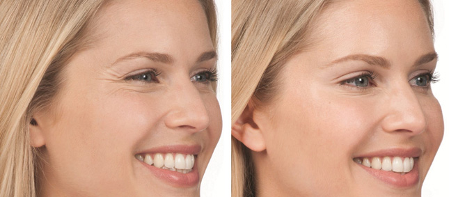 bridal beauty procedures