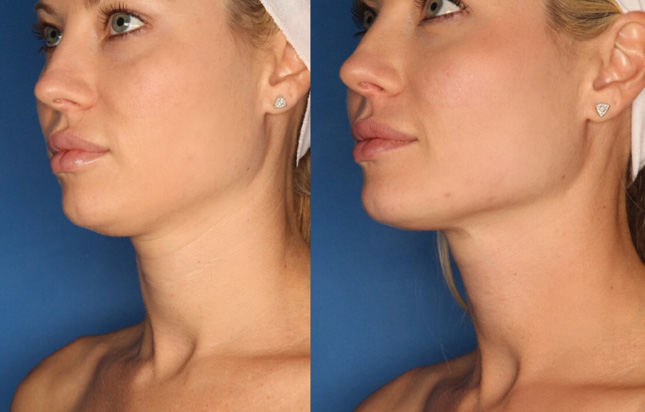 bridal beauty procedures